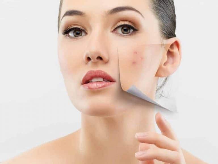Surprisingly Good News About Acne: The Youth Recipe|Skin Care>Professional Skin Care