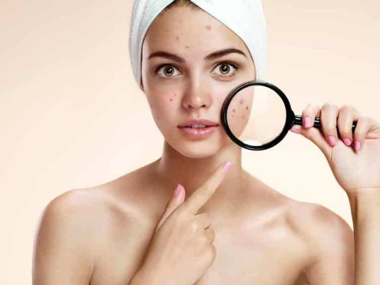 Teenage Acne – How To Beat It?|Advice From Olga Nazarova|Skin Care>Professional Skin Care